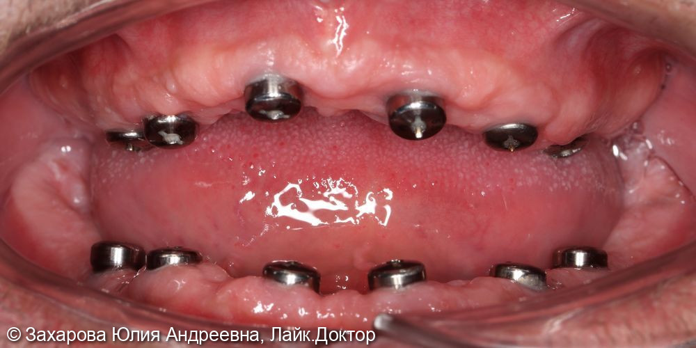 Замещение полного отсутствия зубов на верхней и нижней челюсти циркониевыми мостовидными конструкциями с опорой на имплантаты - фото №2