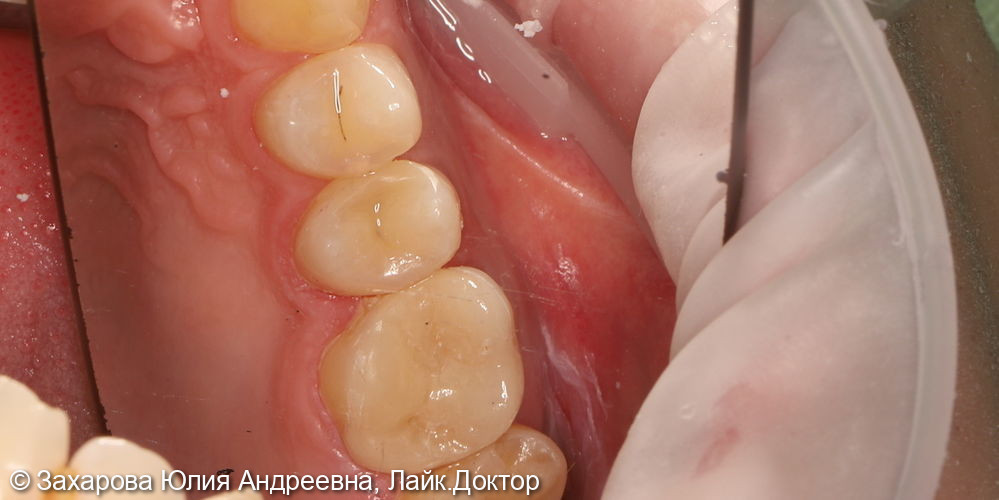 Восстановление анатомической целостности зуба керамической накладкой - фото №1