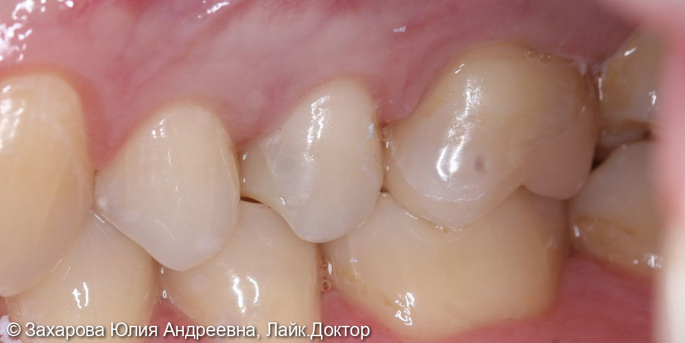 Восстановление анатомической целостности зуба керамической накладкой - фото №2