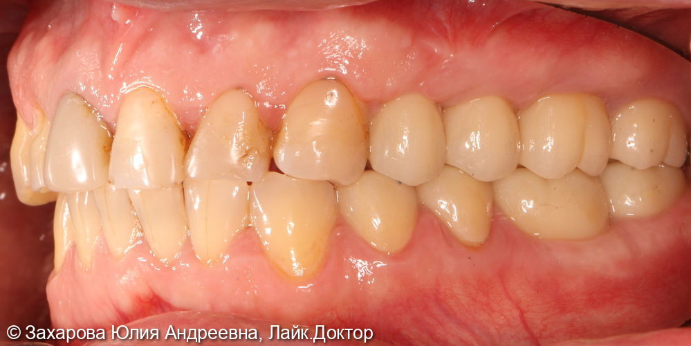 Восстановление частичного отсутствия зубов циркониевыми коронками с опорой на имплантаты - фото №2