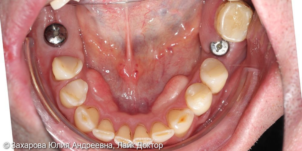 Восстановление частичного отсутствия зубов на нижней челюсти - фото №1