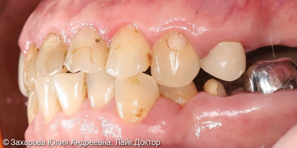 Восстановление анатомической целостности зуба циркониевой коронкой - фото №1