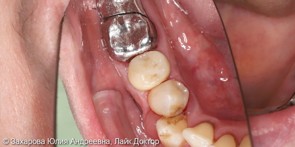 Восстановление анатомической целостности зуба циркониевой коронкой - фото №3