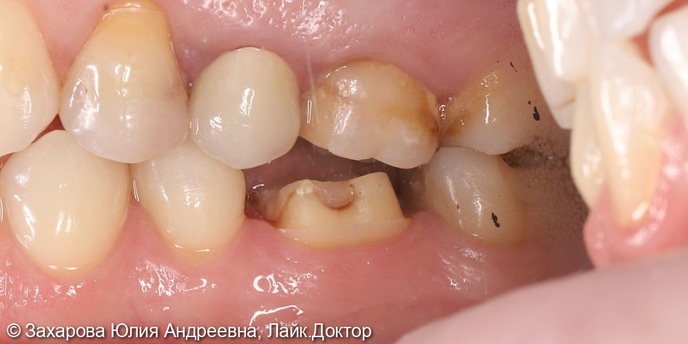 Восстановление анатомической целостости зуба циркониевой коронкой - фото №1