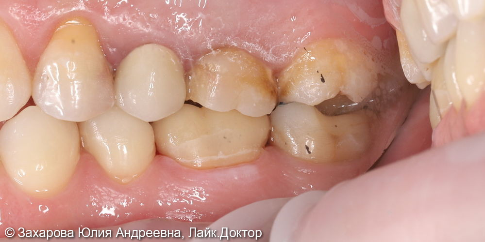 Восстановление анатомической целостости зуба циркониевой коронкой - фото №2