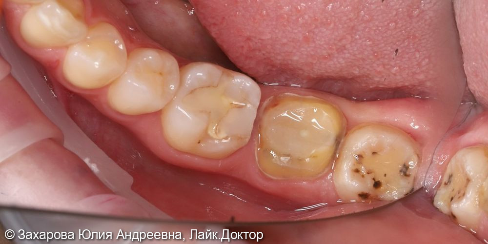 Восстановление анатомической целостности зуба циркониевой коронкой - фото №1
