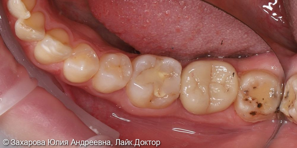 Восстановление анатомической целостности зуба циркониевой коронкой - фото №2