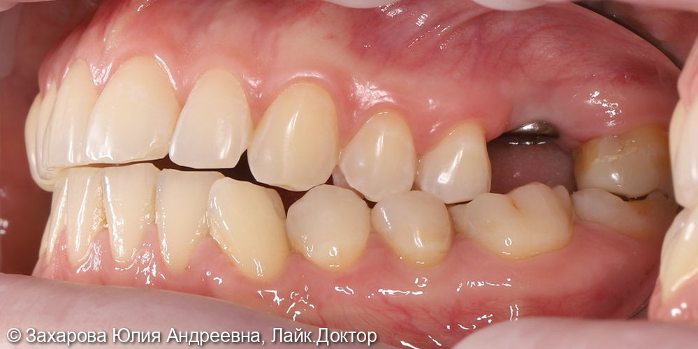 Замещение частичного отсутствия зубов циркониевой коронкой с опорой на имплантат - фото №1