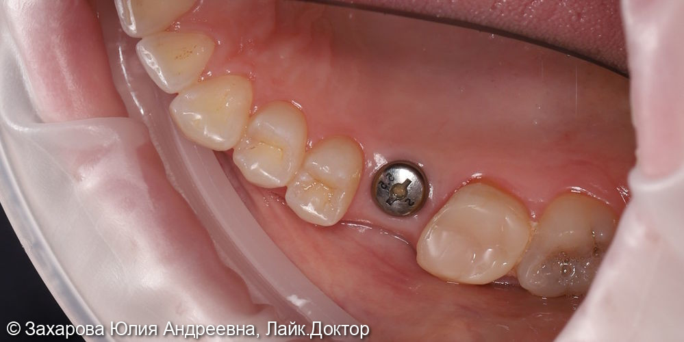 Замещение частичного отсутствия зубов циркониевой коронкой с опорой на имплантат - фото №2