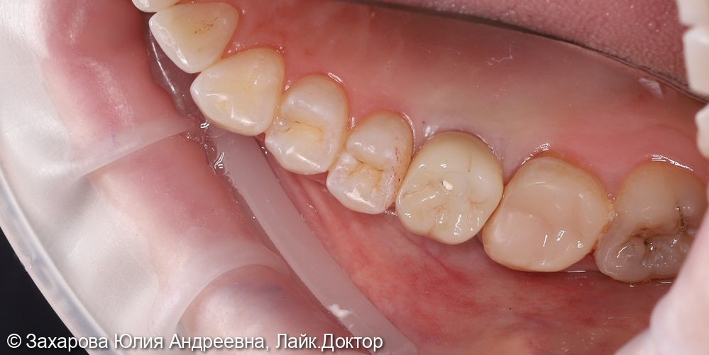 Замещение частичного отсутствия зубов циркониевой коронкой с опорой на имплантат - фото №3