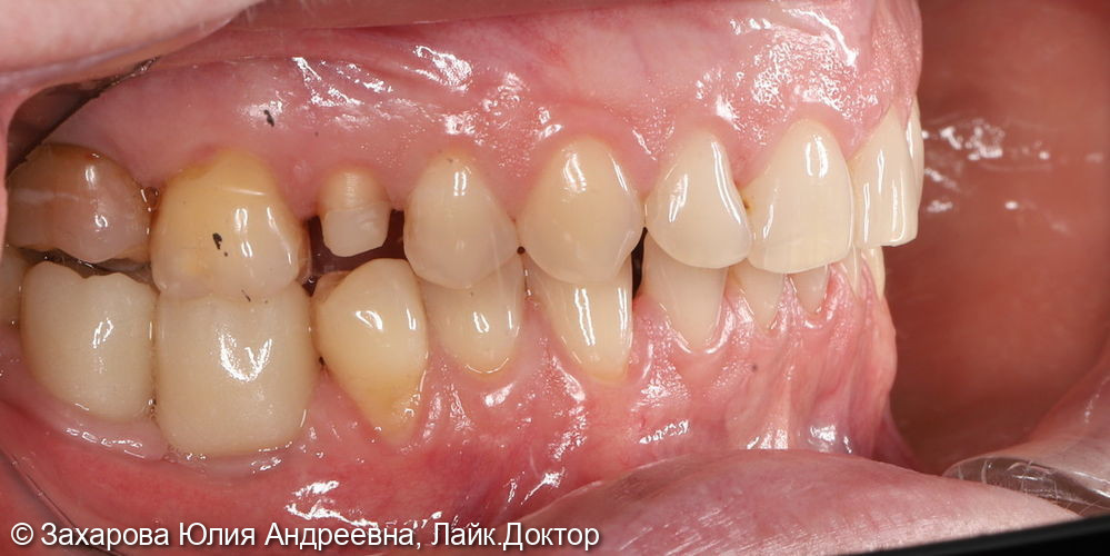 Восстановление анатомической целостности зуба Emax коронкой - фото №1
