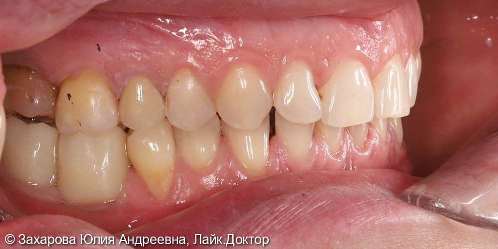 Восстановление анатомической целостности зуба Emax коронкой - фото №2