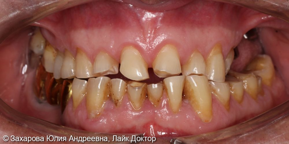 Тотальная реабилитация зубов верхней челюсти - фото №1