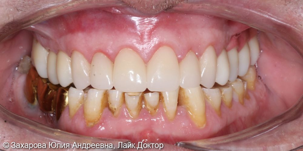 Тотальная реабилитация зубов верхней челюсти - фото №2