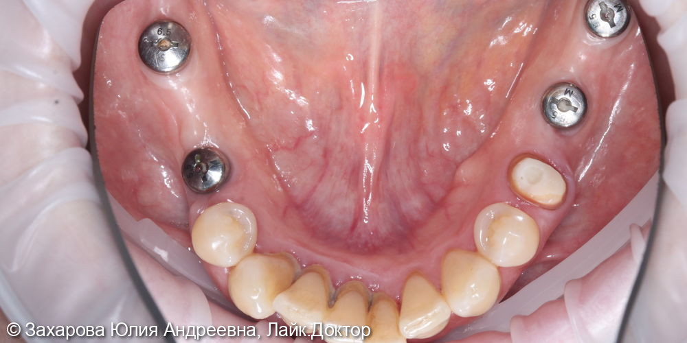 Замещение частичного отсутствия зубов на нижней челюсти - фото №1