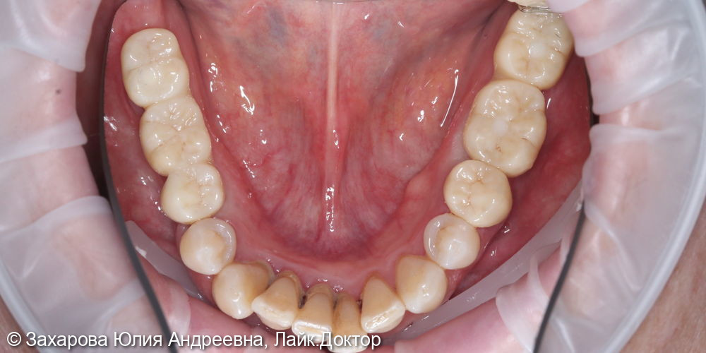 Замещение частичного отсутствия зубов на нижней челюсти - фото №2