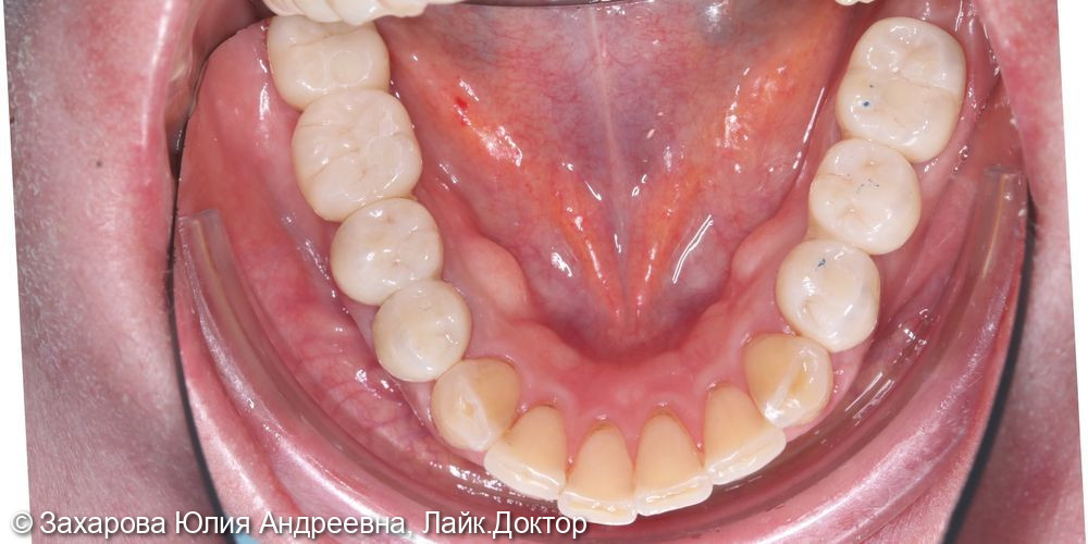 Восстановление частичного отсутствия зубов на нижней челюсти - фото №2