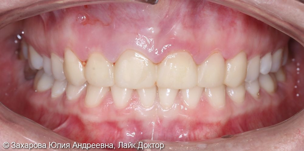 Восстановление зубов керамическими винирами Emax - фото №1