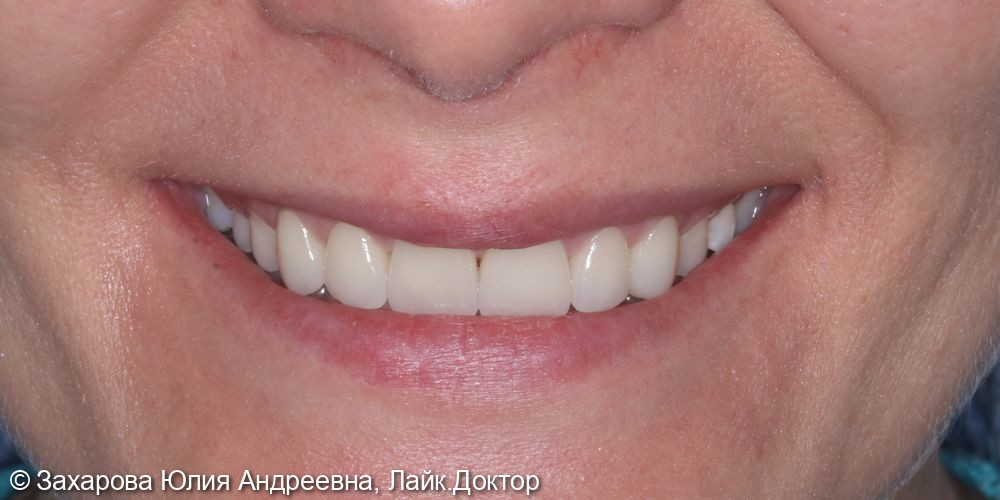 Восстановление зубов керамическими винирами Emax - фото №2