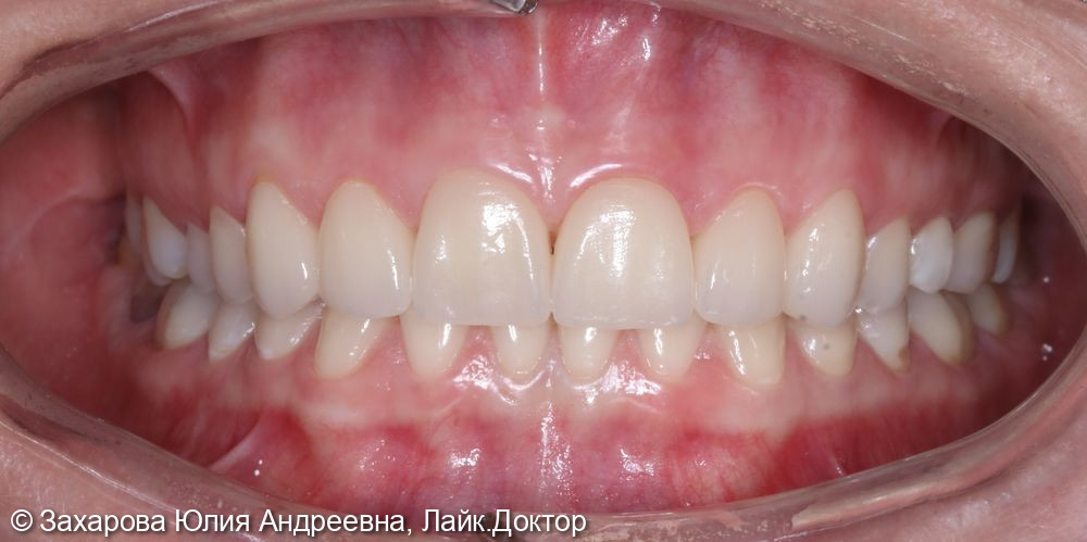 Восстановление зубов керамическими винирами Emax - фото №3