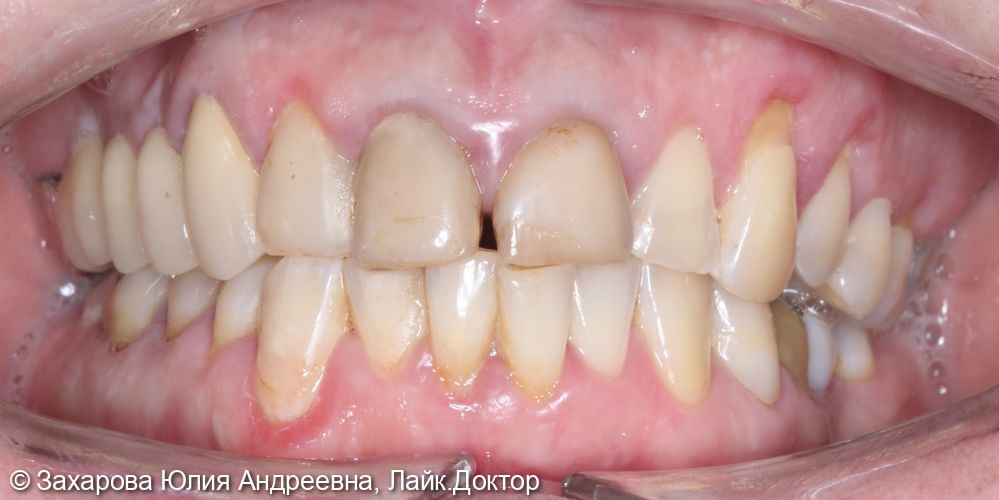 Протезирование фронтальной группы зубов - фото №1
