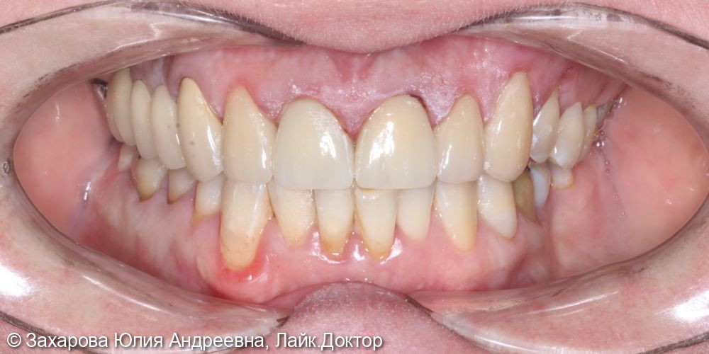 Протезирование фронтальной группы зубов - фото №2