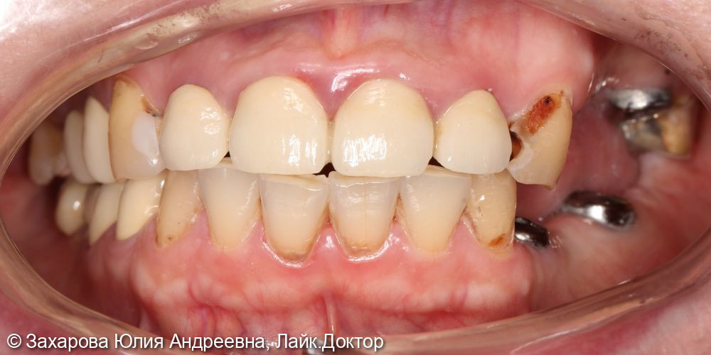 Протезирование с опорой на свои зубы и имплантаты - фото №1