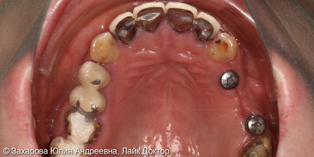 Протезирование с опорой на свои зубы и имплантаты - фото №2