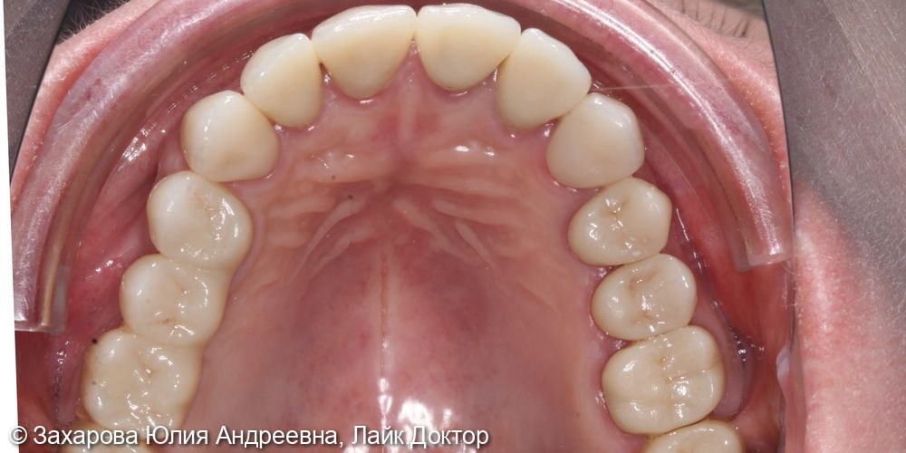 Протезирование с опорой на свои зубы и имплантаты - фото №3