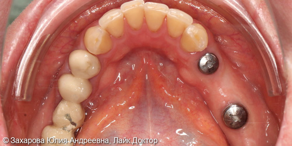 Протезирование с опорой на свои зубы и имплантаты - фото №4