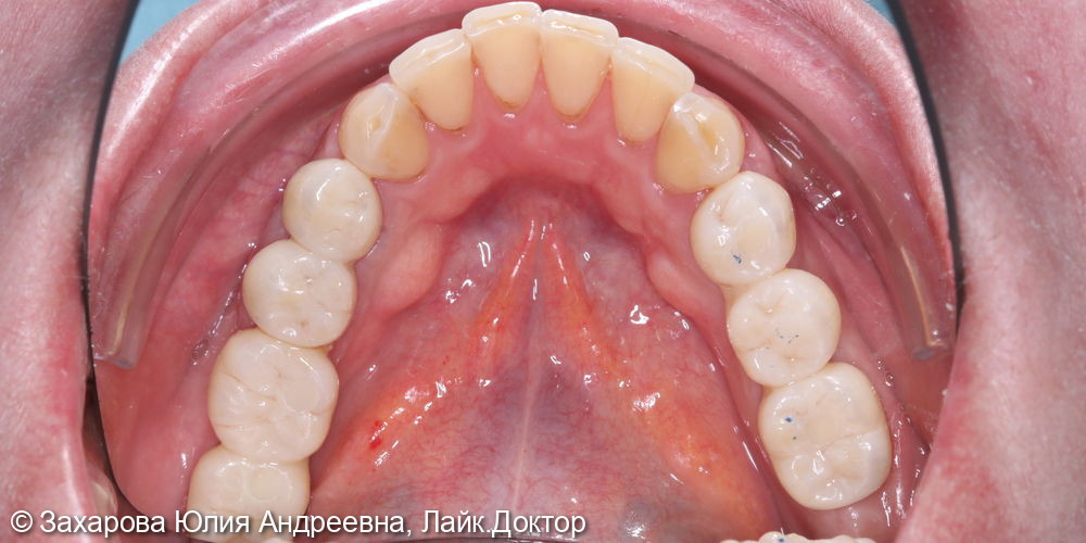 Протезирование с опорой на свои зубы и имплантаты - фото №5