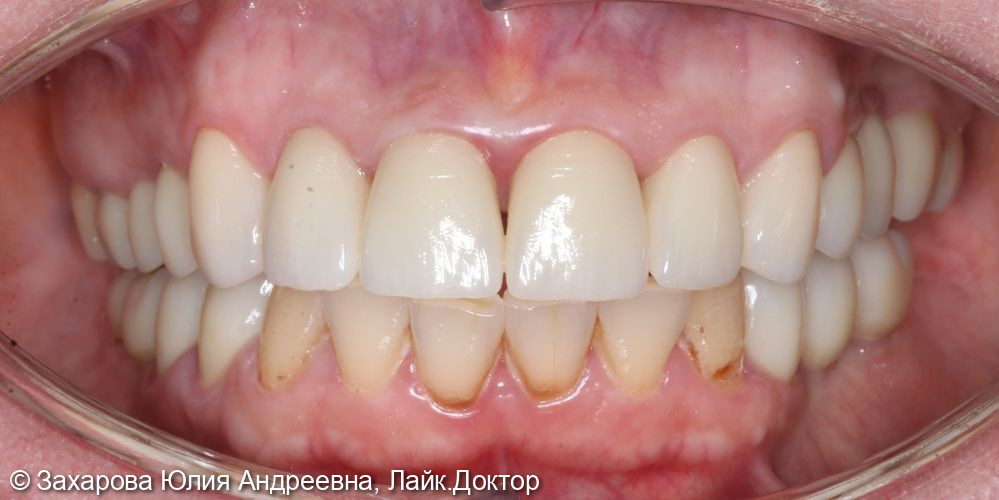 Протезирование с опорой на свои зубы и имплантаты - фото №6