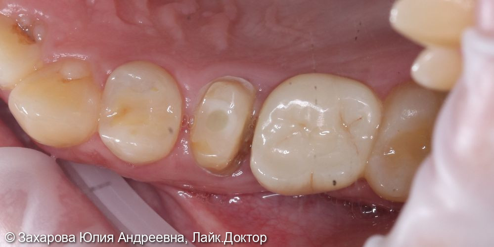 Восстановление зуба коронкой из диоксида циркония - фото №2