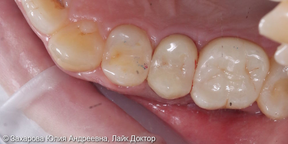 Восстановление зуба коронкой из диоксида циркония - фото №3