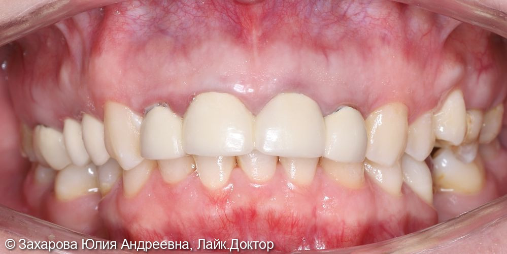 Восстановление зубов коронками и винирами - фото №1