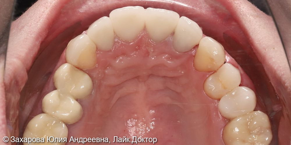 Восстановление зубов коронками и винирами - фото №3