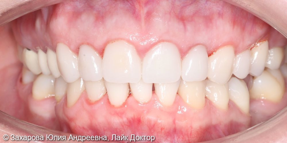 Восстановление зубов коронками и винирами - фото №5