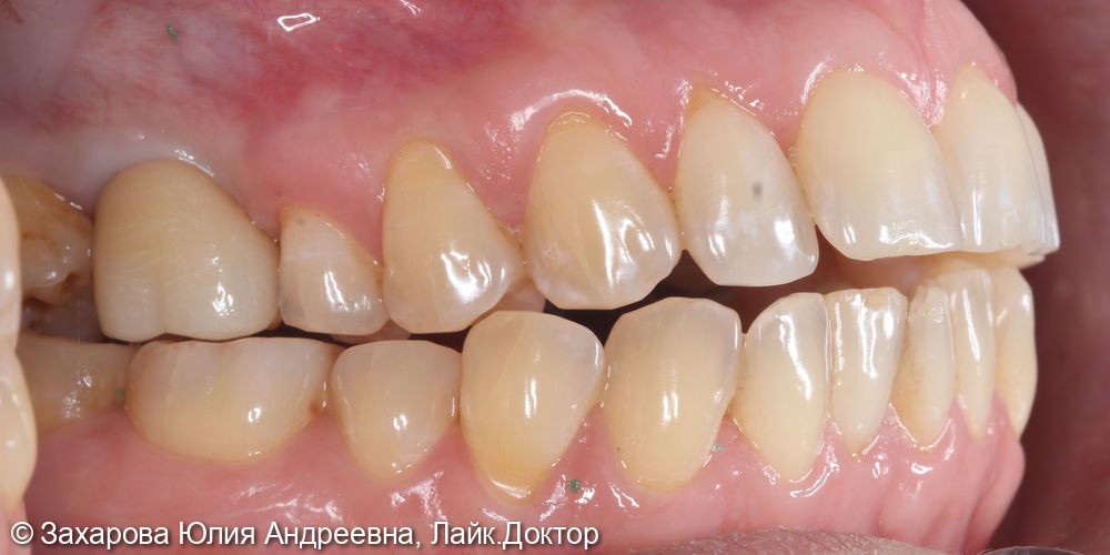 Восстановление частичного отсутствия зубов коронками с опорой на имплантаты - фото №2