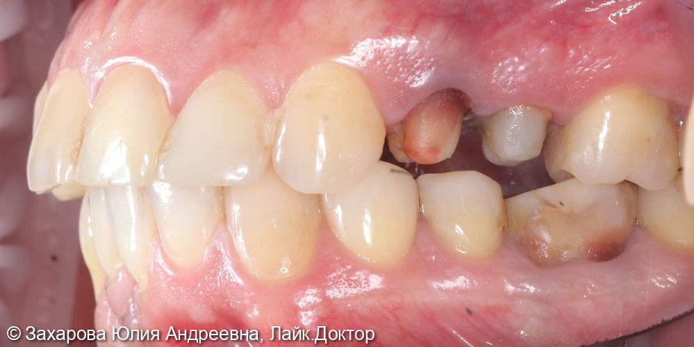 Восстановление зубов коронками из диоксида циркония - фото №1