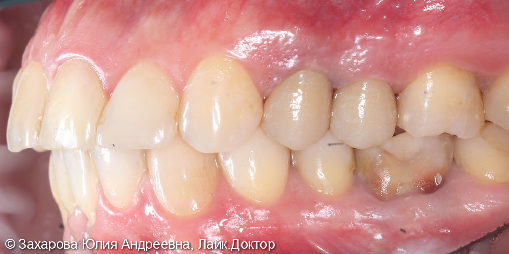 Восстановление зубов коронками из диоксида циркония - фото №2