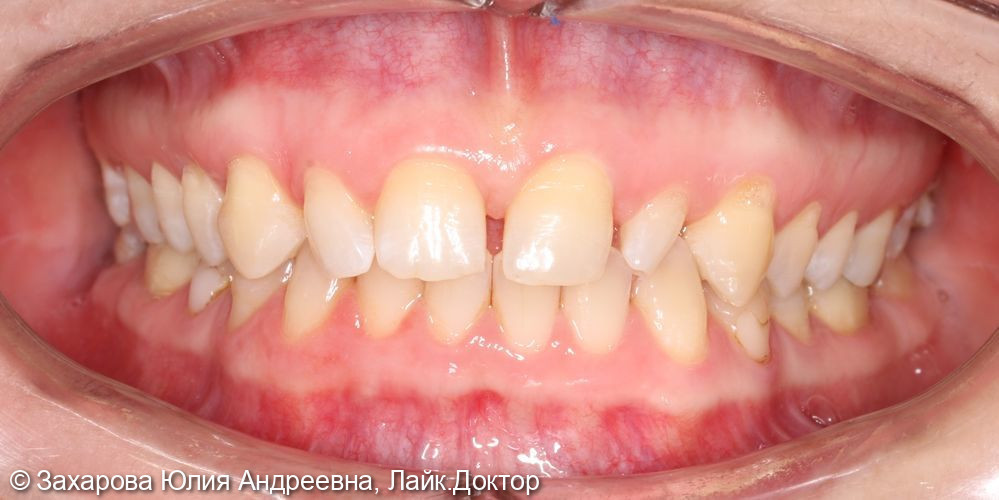 Восстановление фронтальной группы зубов керамическими винирами - фото №1