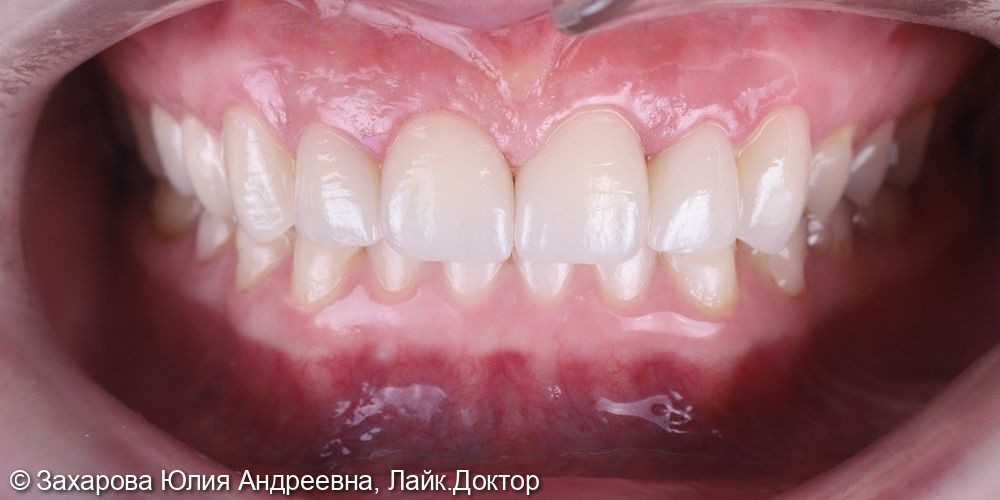 Восстановление фронтальной группы зубов керамическими винирами - фото №6