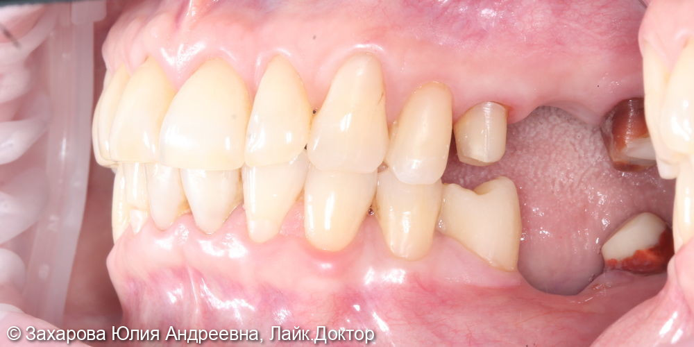Восстановление частичного отсутствия зубов мостовидными конструкциями - фото №1