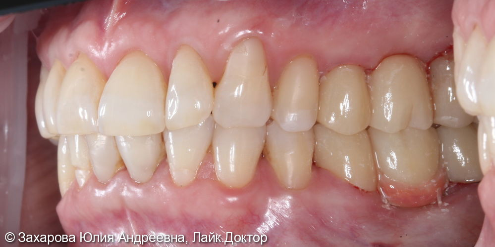 Восстановление частичного отсутствия зубов мостовидными конструкциями - фото №2