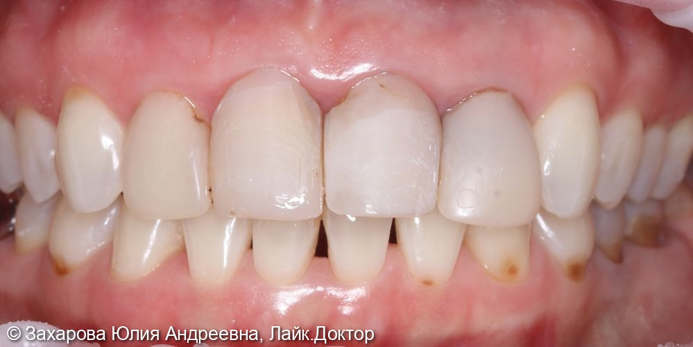 Восстановление анатомической целостности зубов Emax коронками - фото №1