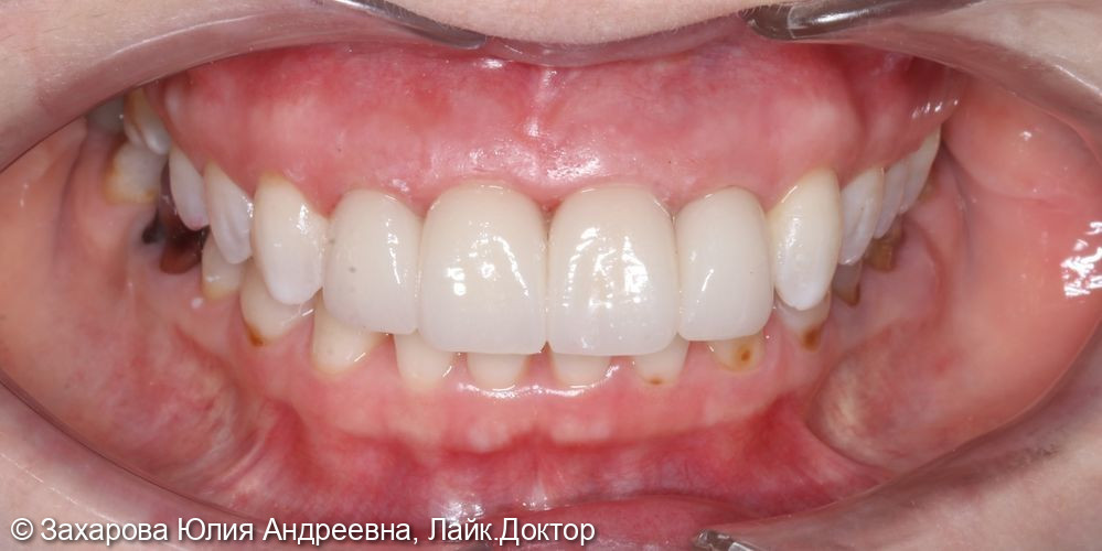 Восстановление анатомической целостности зубов Emax коронками - фото №3