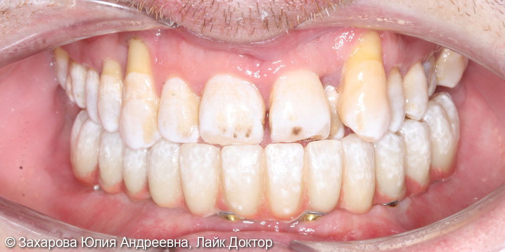 Протезирование с опорой на имплантаты при полном отсутствии зубов - фото №2