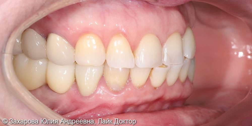 Протезирование с опорой на свои зуба и имплантаты - фото №2