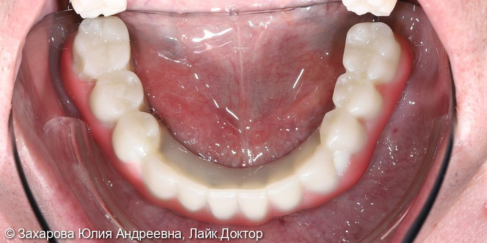 Протезирование балочными конструкциями при полном отсутствии зубов - фото №5