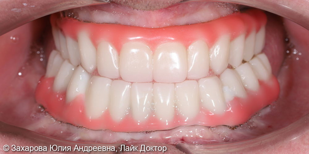 Протезирование балочными конструкциями при полном отсутствии зубов - фото №6